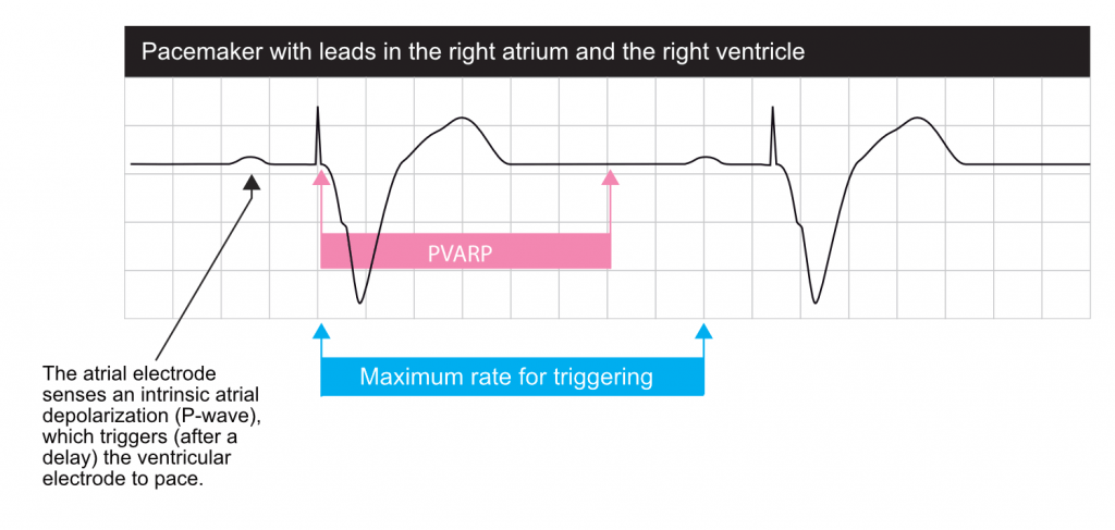 Basic cardiac pacing, pacemaker functions and settings ECG & ECHO