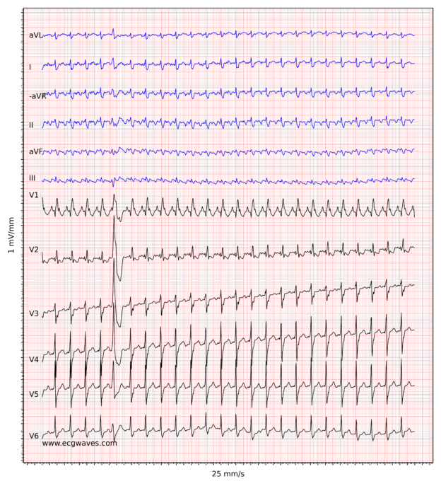 Atrial flutter classification, causes, ECG diagnosis & management