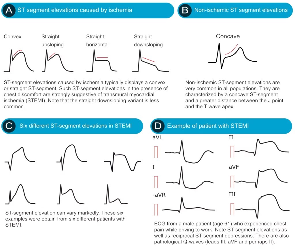 ECG interpretation Characteristics of the normal ECG (Pwave, QRS