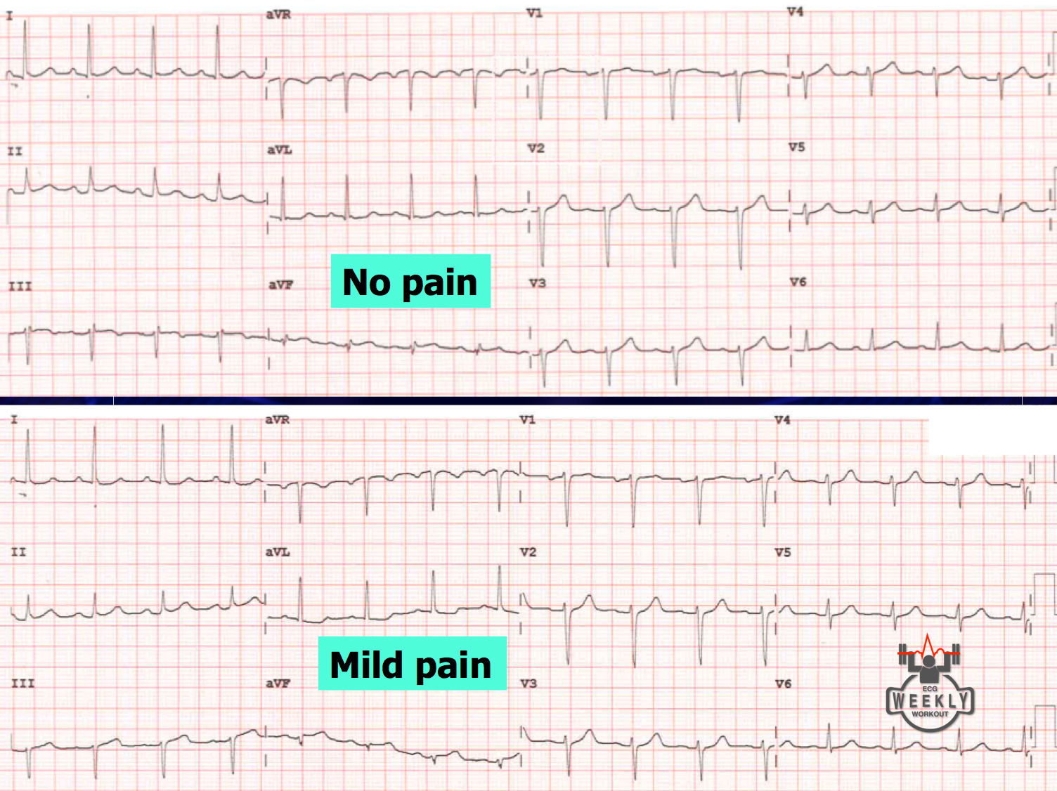 Early reciprocal changes ECG Weekly
