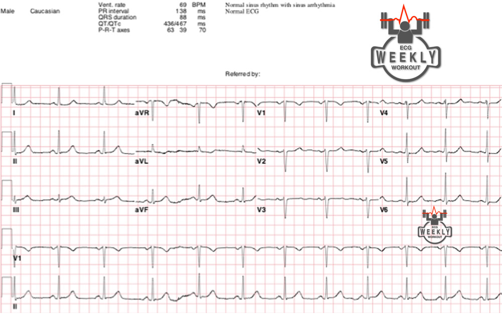 Early reciprocal changes ECG Weekly