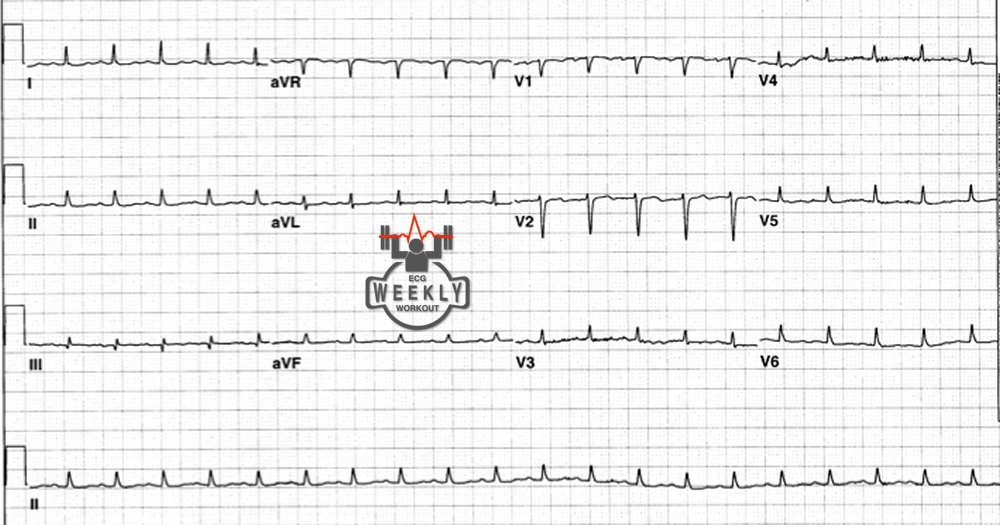 Amal Mattu’s ECG Case of the Week September 25, 2017