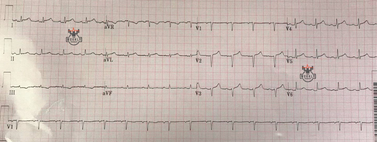 Amal Mattu’s ECG Case of the Week August 5, 2019 ECG