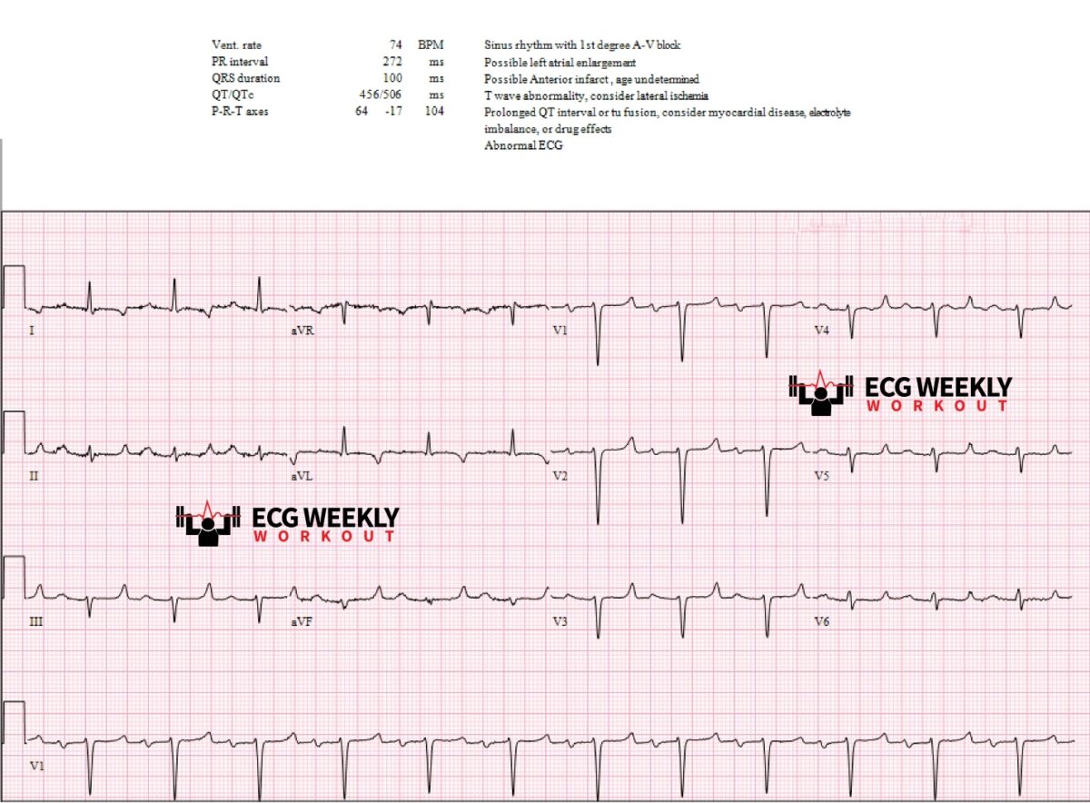 Differential Diagnoses poor R wave progression, prolonged QT intervals