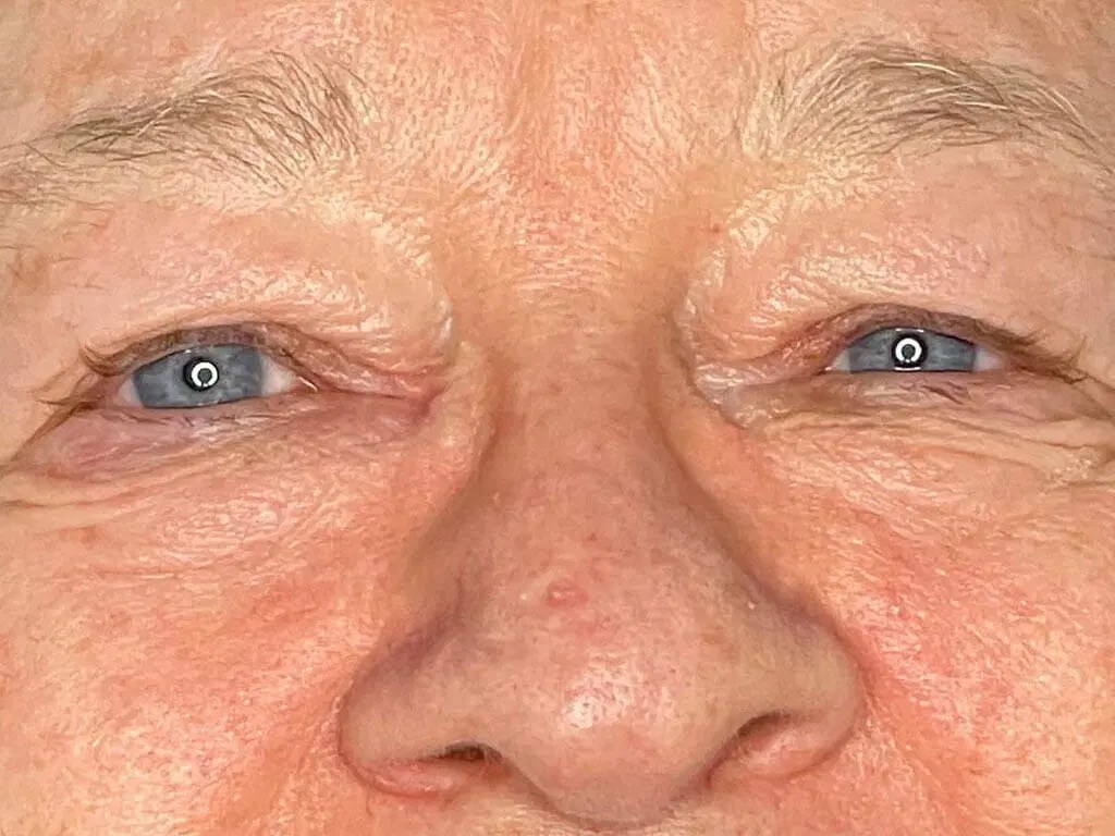 Rosemary's Upper Eyelid Surgery Journey Patient Stories Bella Vou