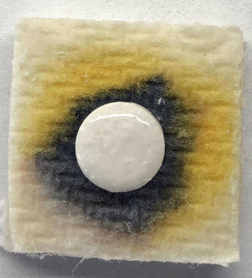 cholestasis Archives eClinpath