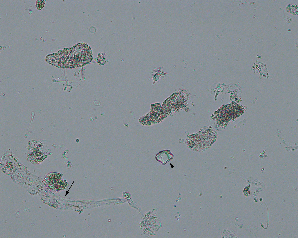 Urine casts eClinpath