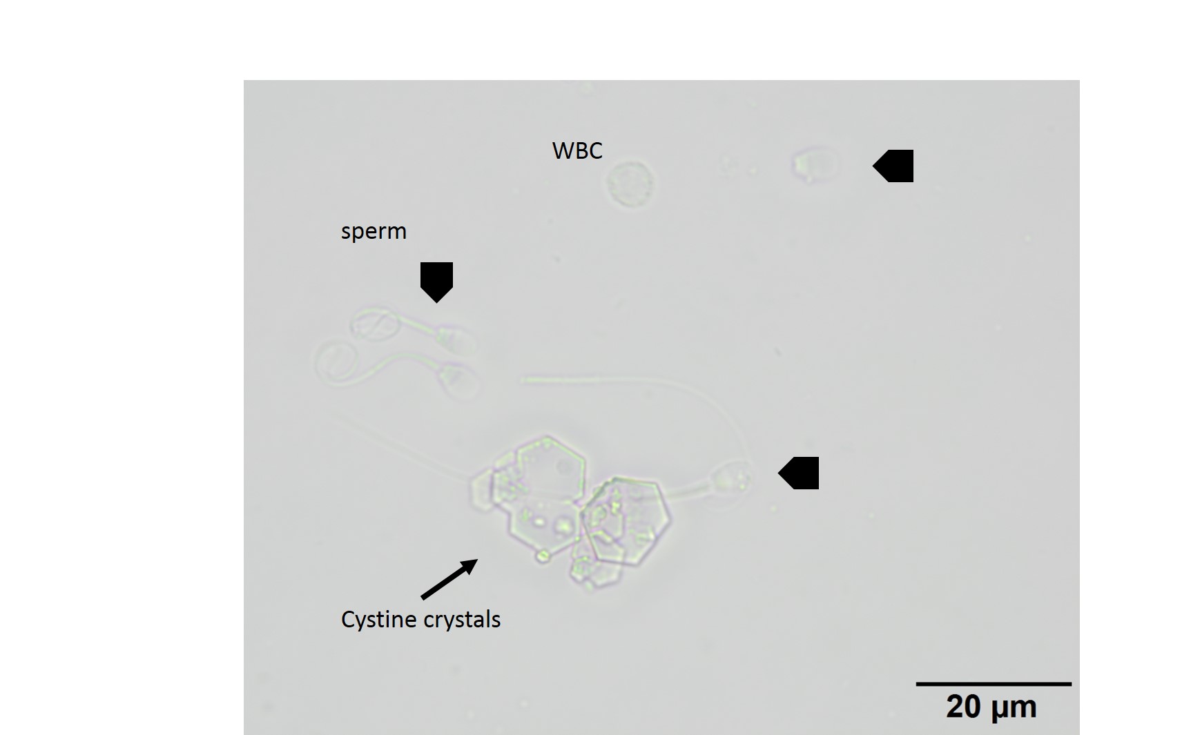 Figure 4 Urine sediment from a dog with cystine urolithiasis eClinpath