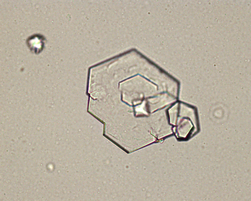 Cystine crystals eClinpath