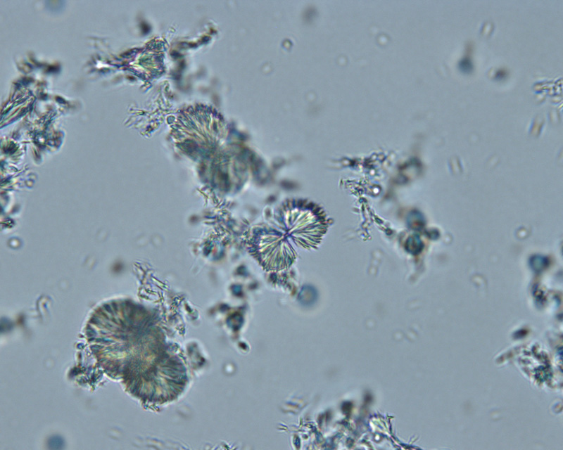Sulfur crystals (presumptive) eClinpath