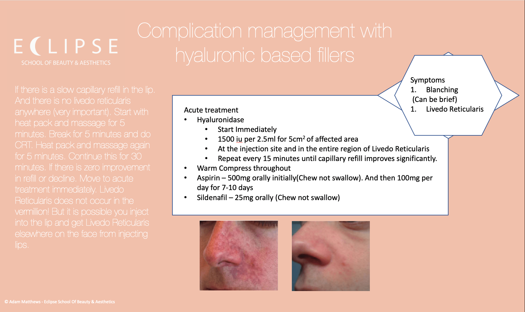 Video of a vascular occlusion from dermal fillers Eclipse