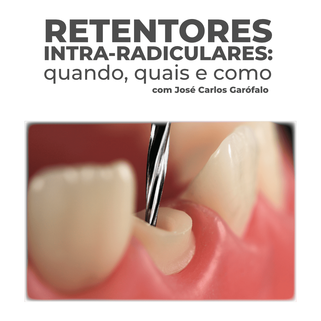 Retentores Intraradiculares quando, quais e como • ECO Academy