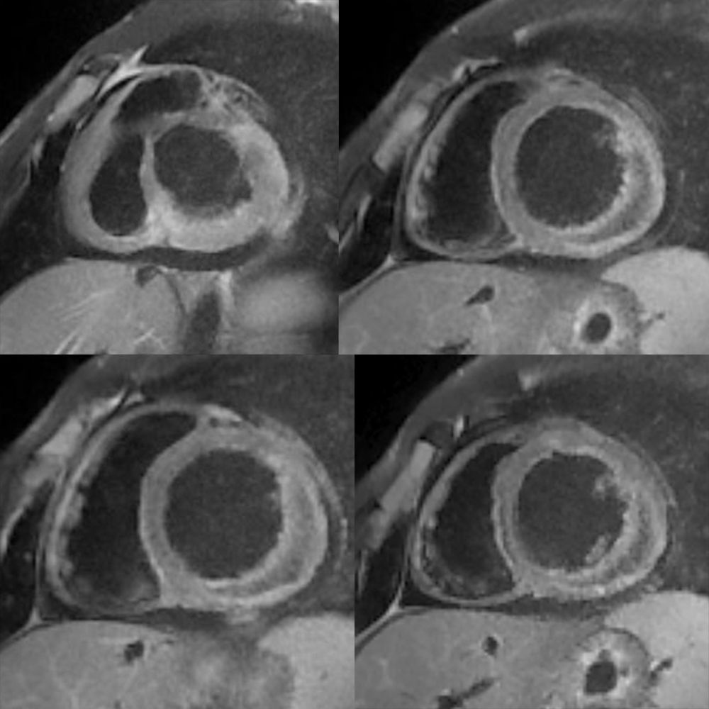 Hemorragia intramiocÃ¡rdica tras infarto agudo de miocardio