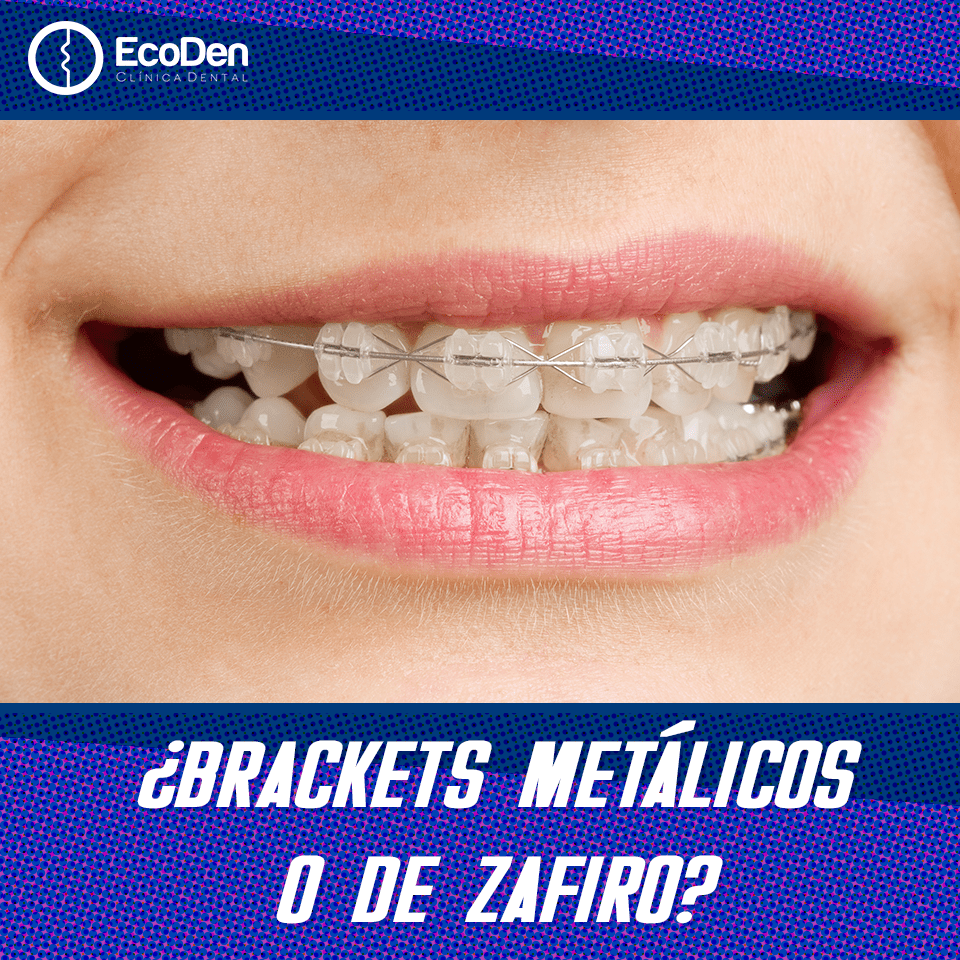 ¿Brackets metálicos o de zafiro?