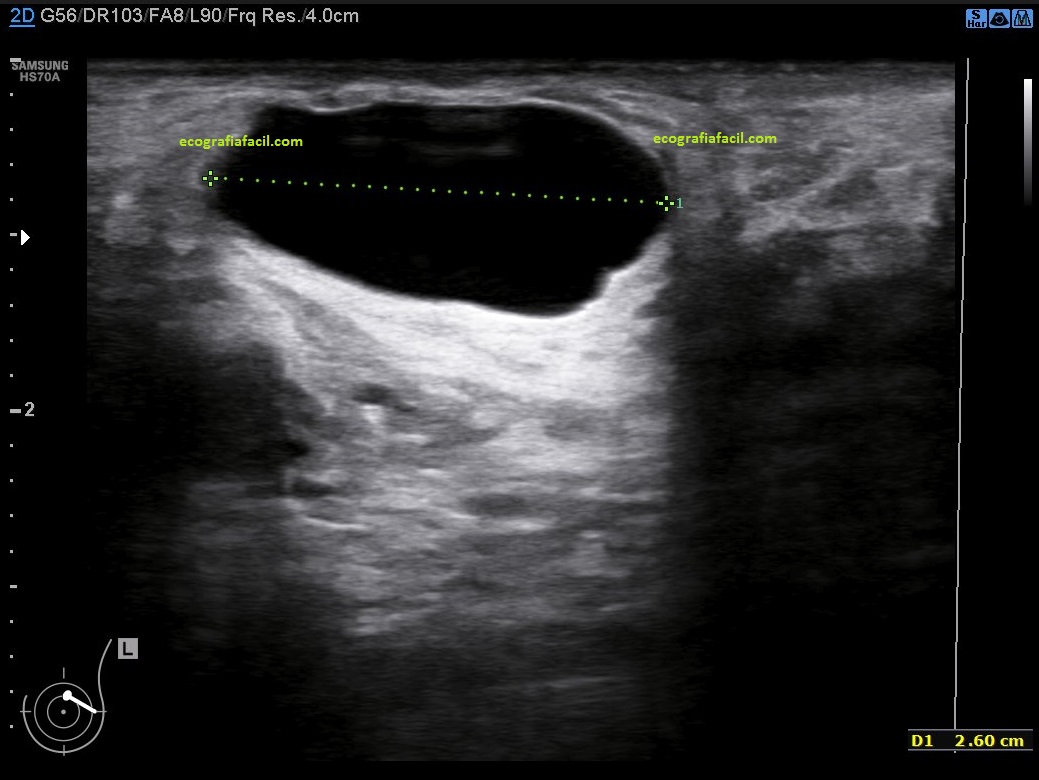 Quiste Ecografía Fácil