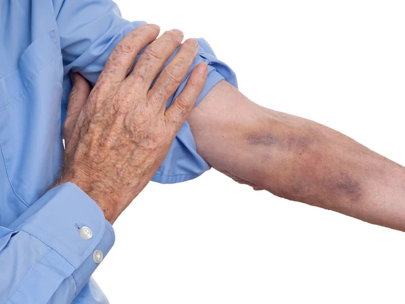 Why Does Alcohol Cause Bruising? EcoSoberHouse