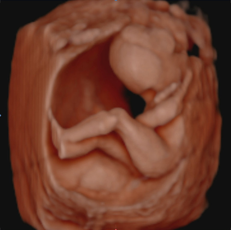 Ecografia 18 semanas de gravidez Ecox4D