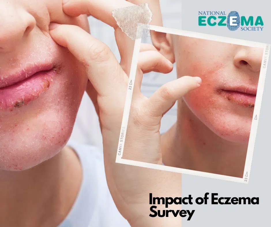 Impact of Eczema Survey National Eczema Society
