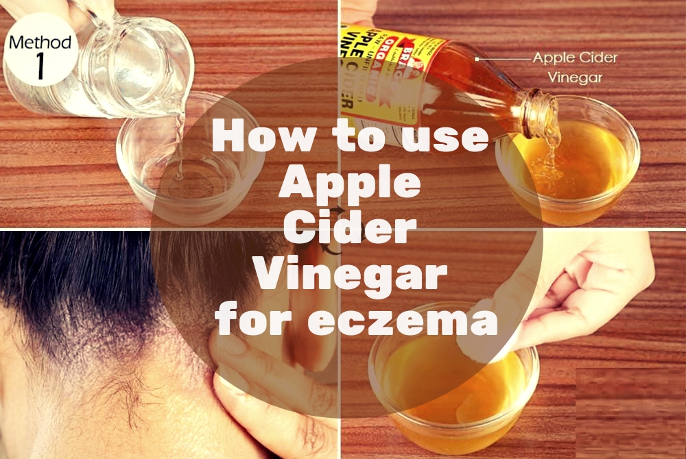 Apple Cider Vinegar for Eczema Treatment Does it Really Work?