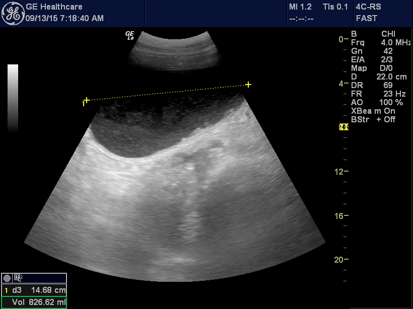 Troubleshooting Foley catheters EDE Blog