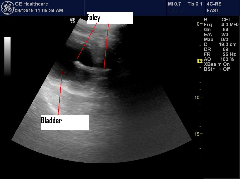 Troubleshooting Foley catheters EDE Blog