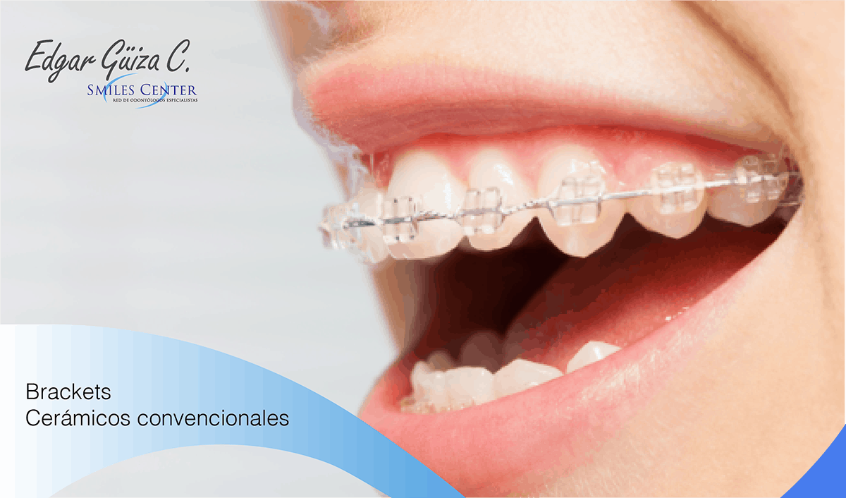 SERVICIOS EDGAR GÜIZA. Odontólogo y rehabilitador oral Bogotá. Blanqueamiento dental