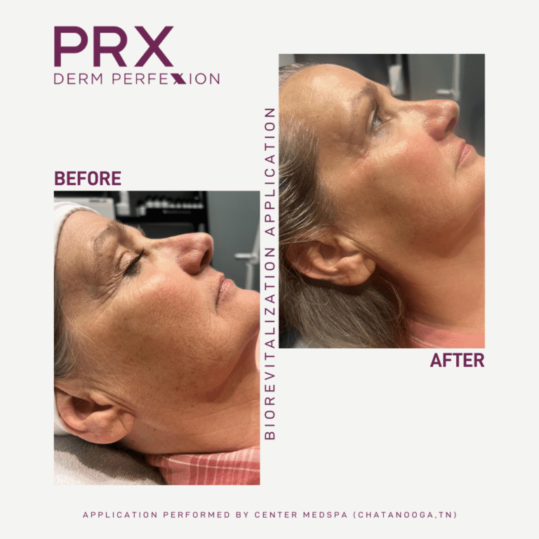 PRX Derm Perfexion Treatment Edina Skin Care