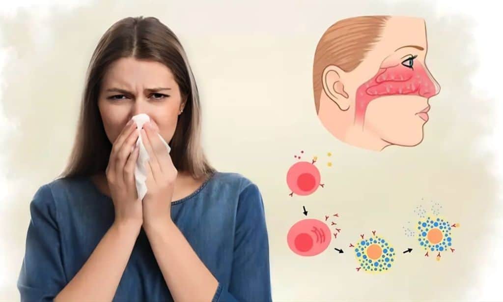 Allergic Rhinitis SelfCare 30 Best Tips to Manage Rhinitis Symptoms