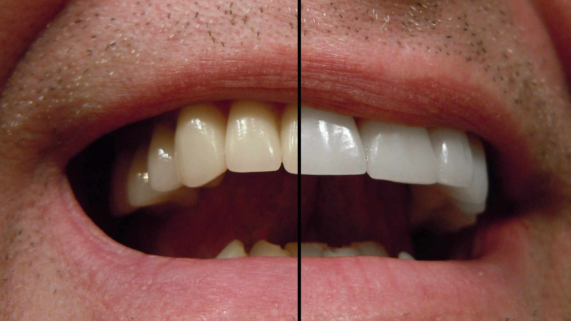 Quick method to whiten teeth in Edit with Kim