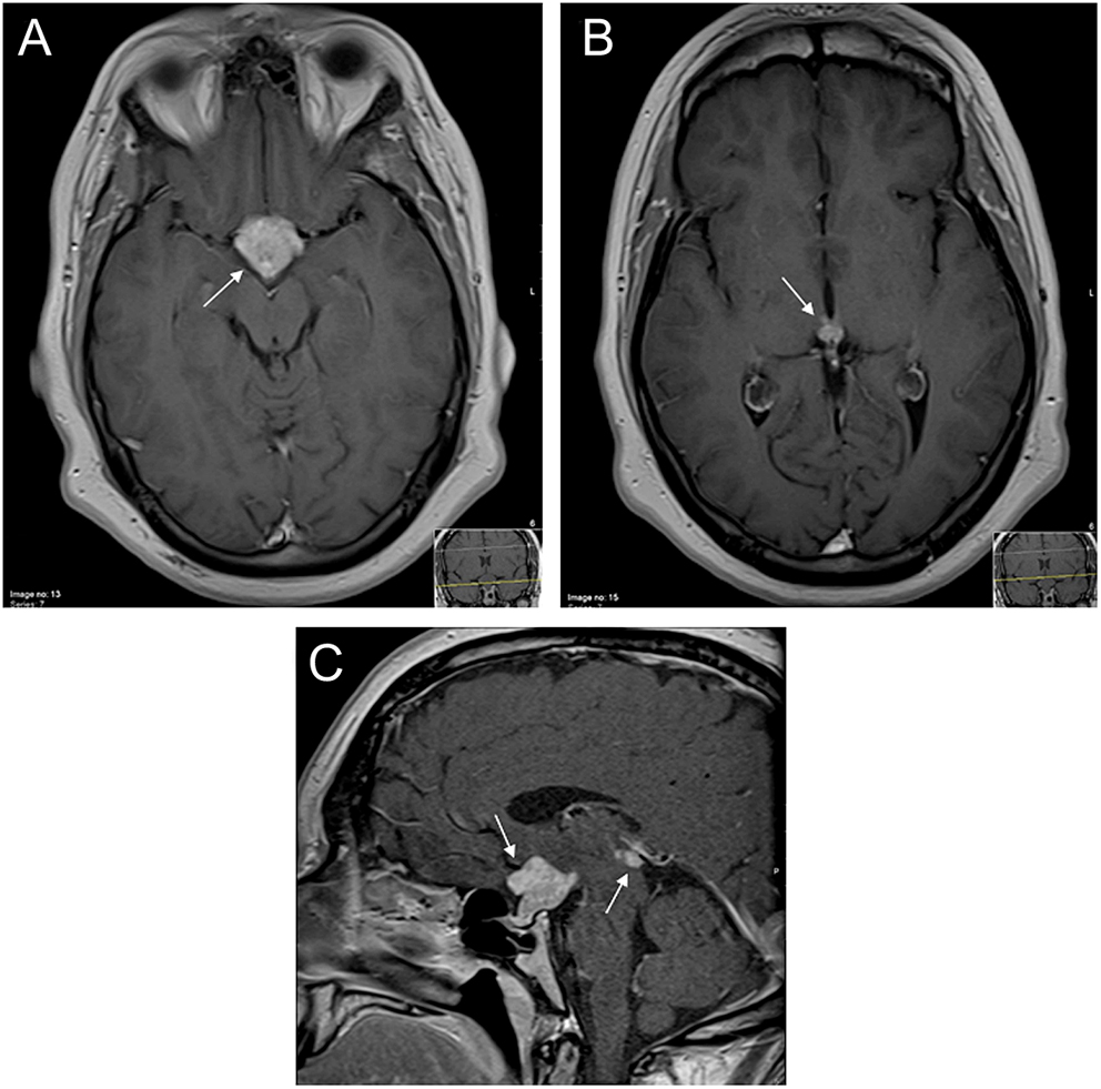 Bifocal germinoma in a patient with 16p11.2 microdeletion syndrome in