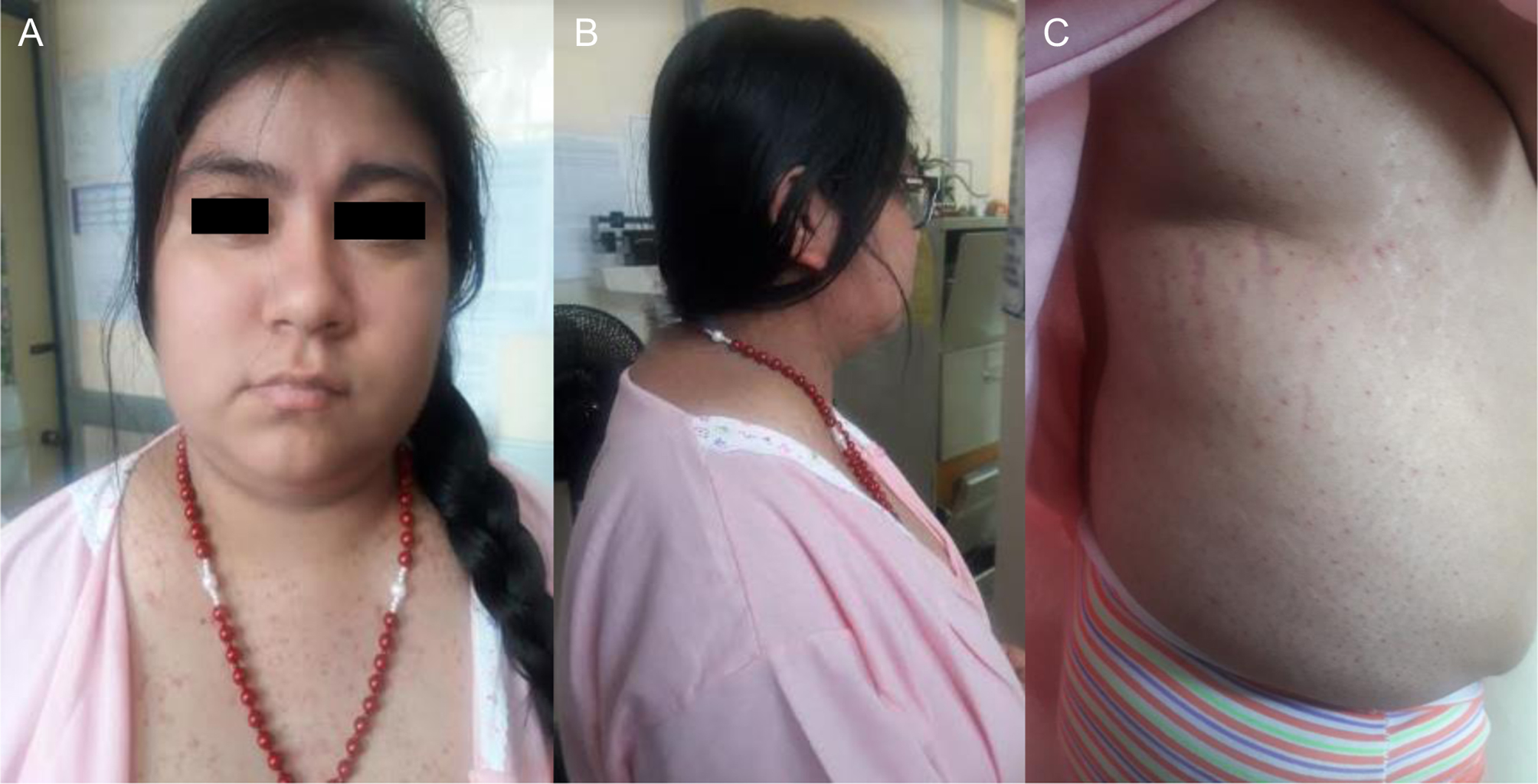 Pregnancy during the course of Cushing’s syndrome a case report and