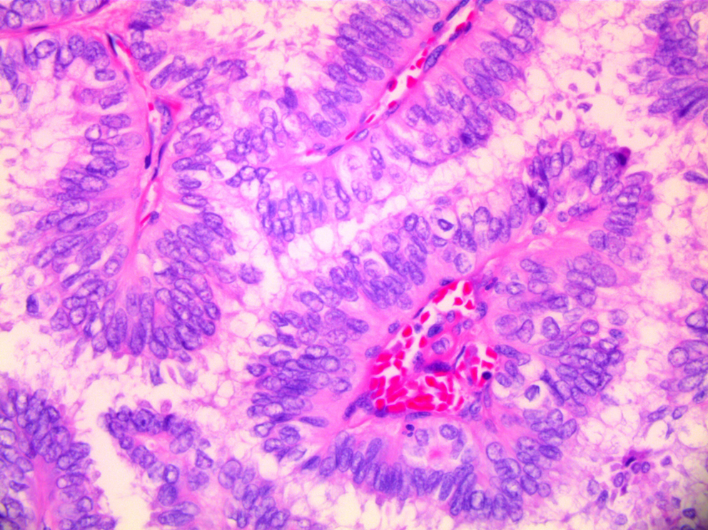 Rare distant metastases to pancreas, liver, and lung as initial