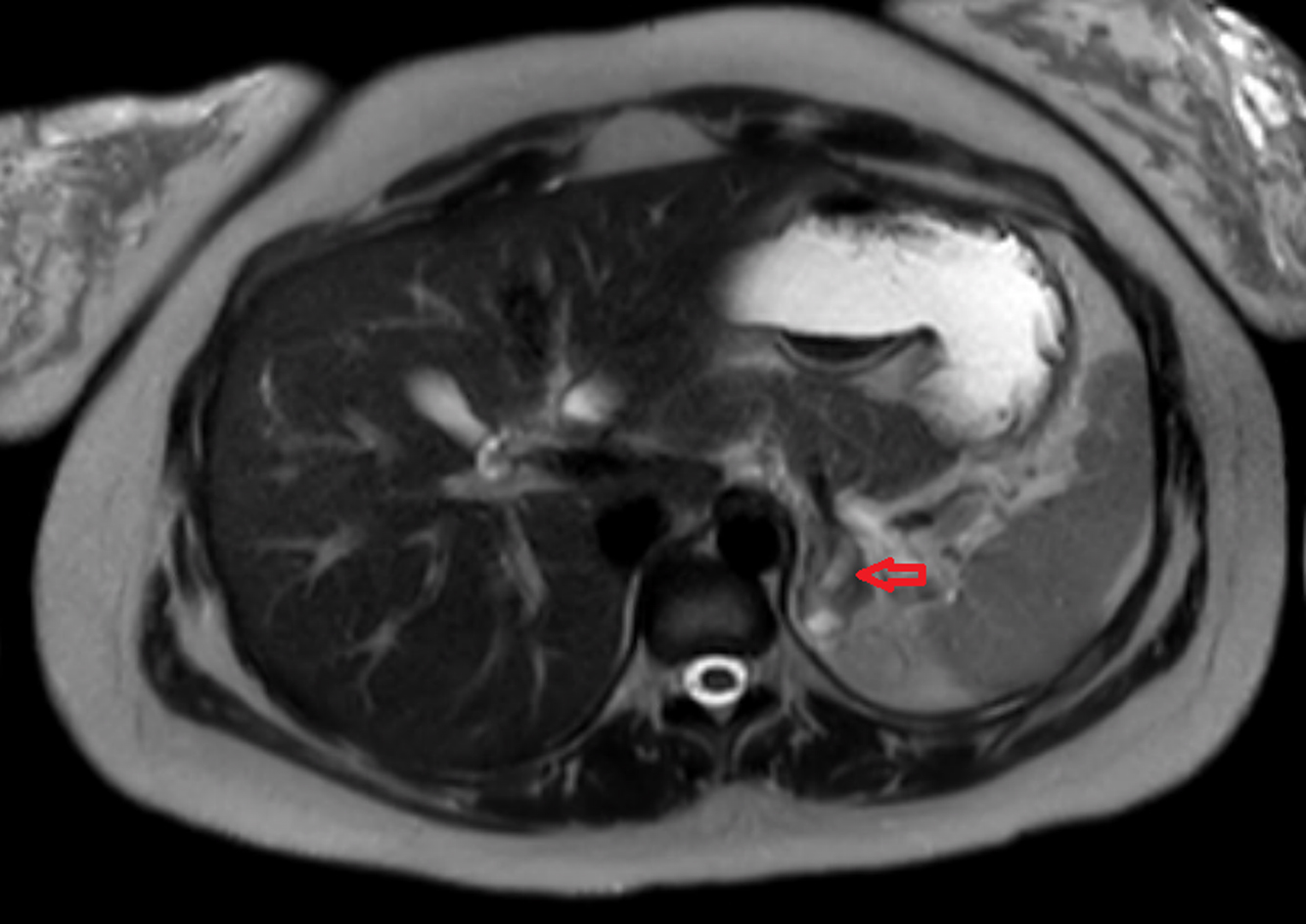 Newonset primary adrenal insufficiency in pregnancy associated with a
