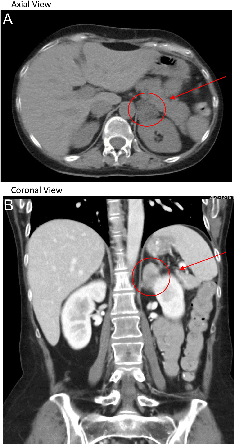 Amenorrhea as a presentation of Cushing’s syndrome in Endocrinology