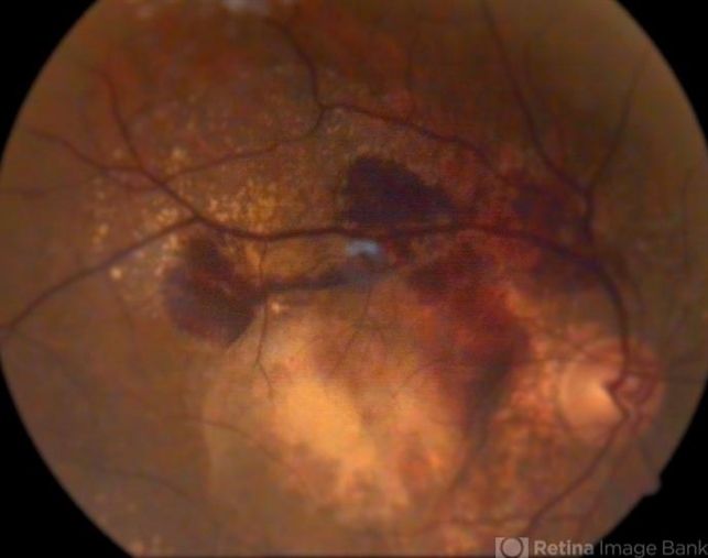 AgeRelated Macular Degeneration (ARMD) management strategies