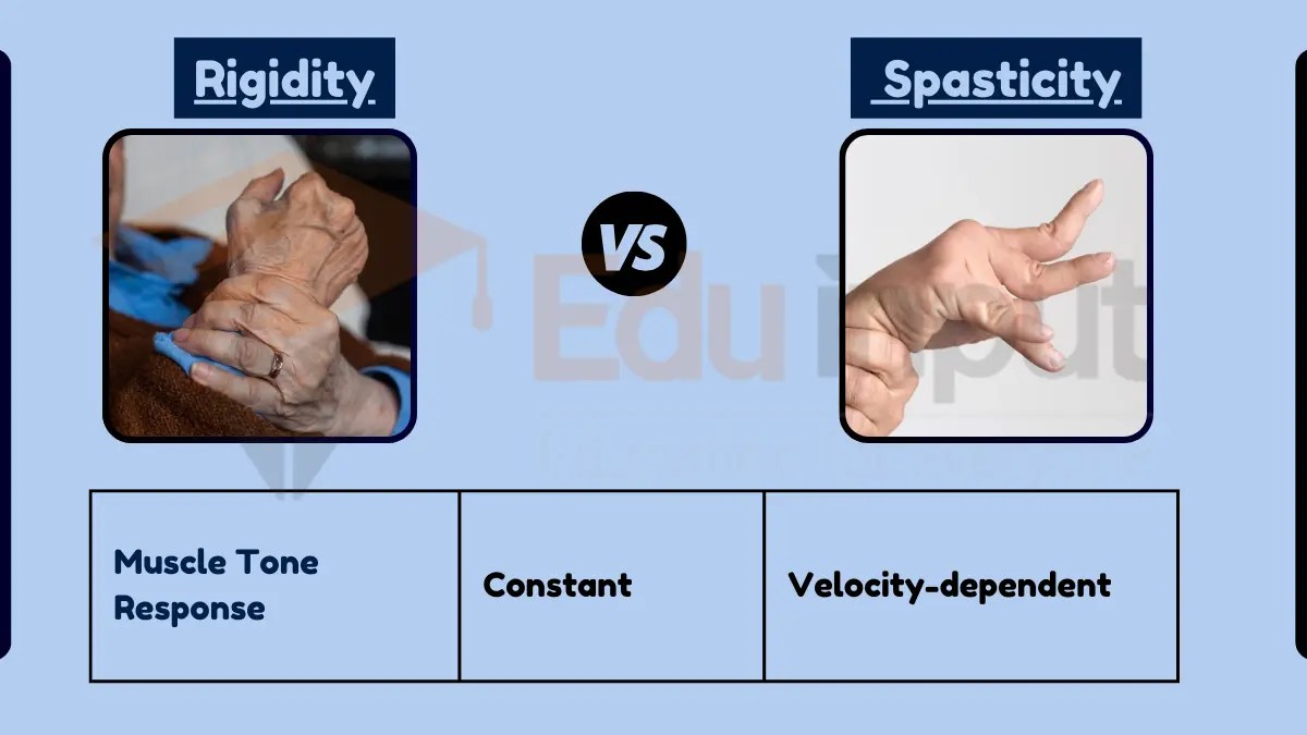 Difference Between Rigidity and Spasticity