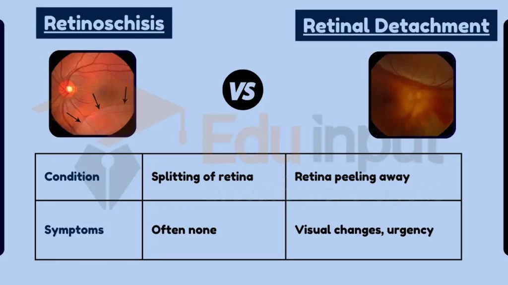 Difference Between Retinoschisis and Retinal Detachment