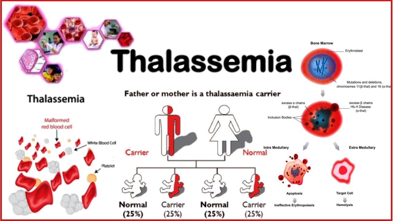 WHAT IS THALASSEMIA? EDUINDEX NEWS
