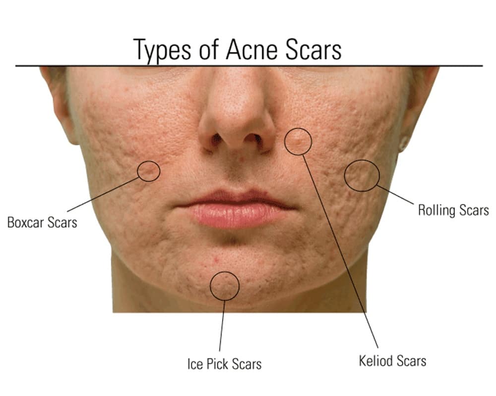 Rejuran S Acne Scar Treatment Improve Scars Now! Edwin Lim Medical