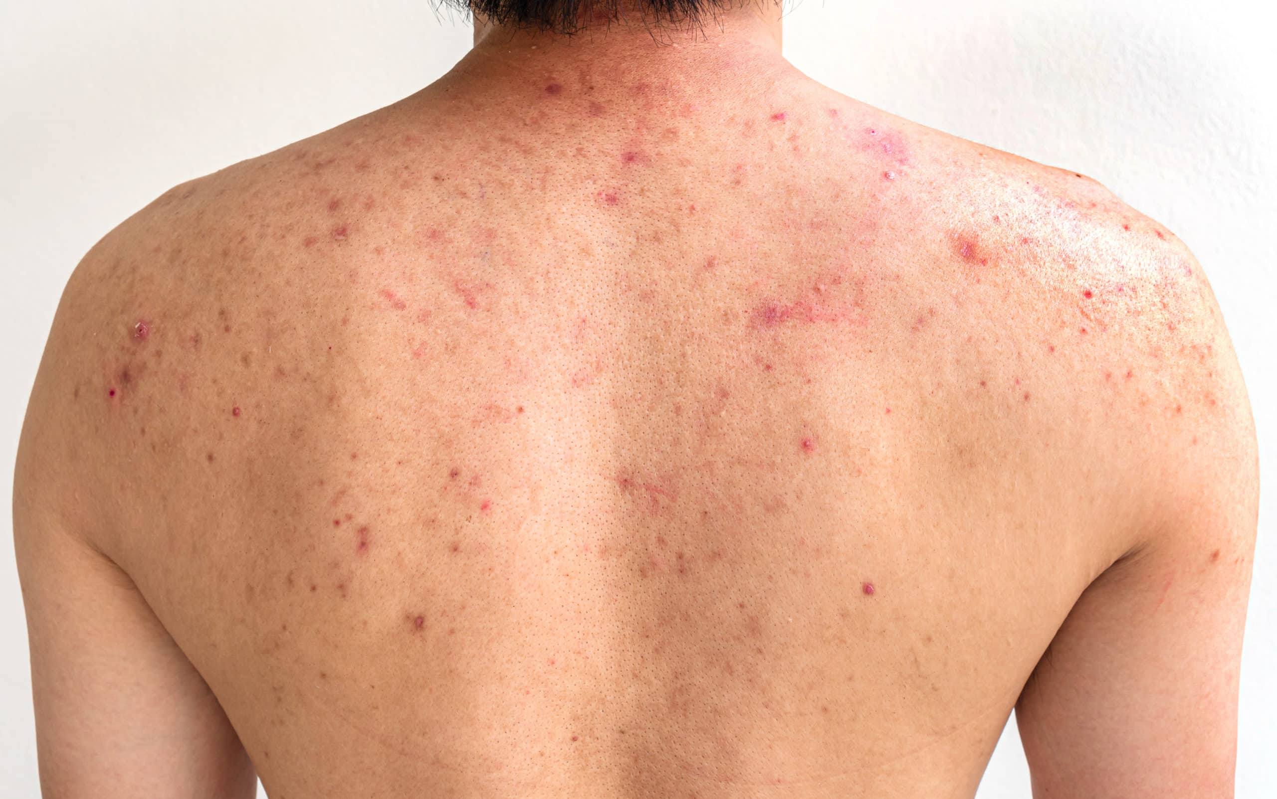 Back Acne and Body Acne Treatment Guide Singapore Edwin Lim Medical Aesthetic Clinic