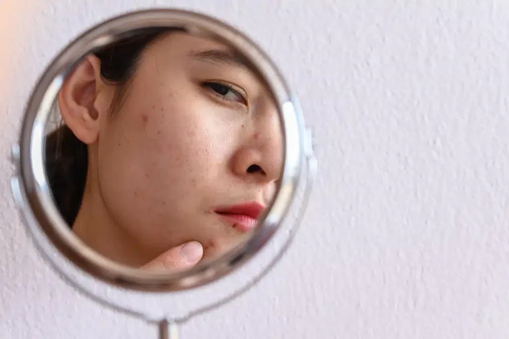 Doxycycline Singapore Acne Medication Guide Edwin Lim Medical Aesthetic Clinic
