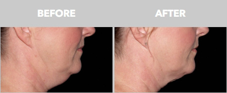 CoolSculpting Fat Freezing Treatment | EE Clinic