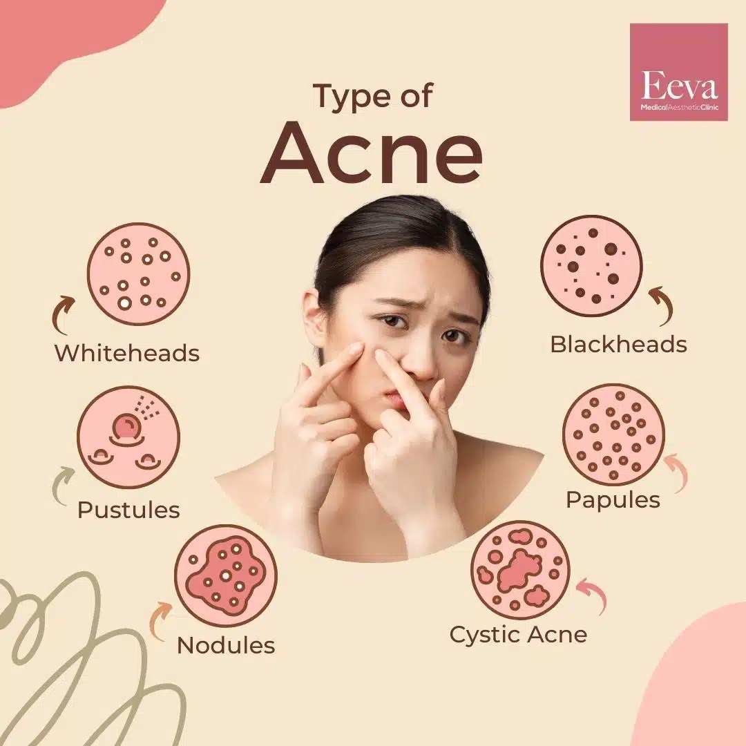 What is Acne? Explained Prevention, Causes and Treatments Eeva