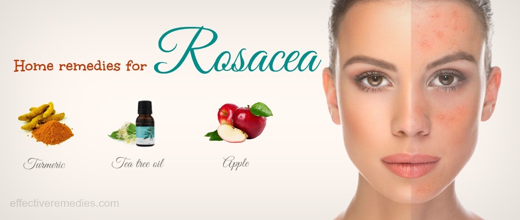 9 Best Home Remedies For Rosacea On Face Natural & Safe Ways
