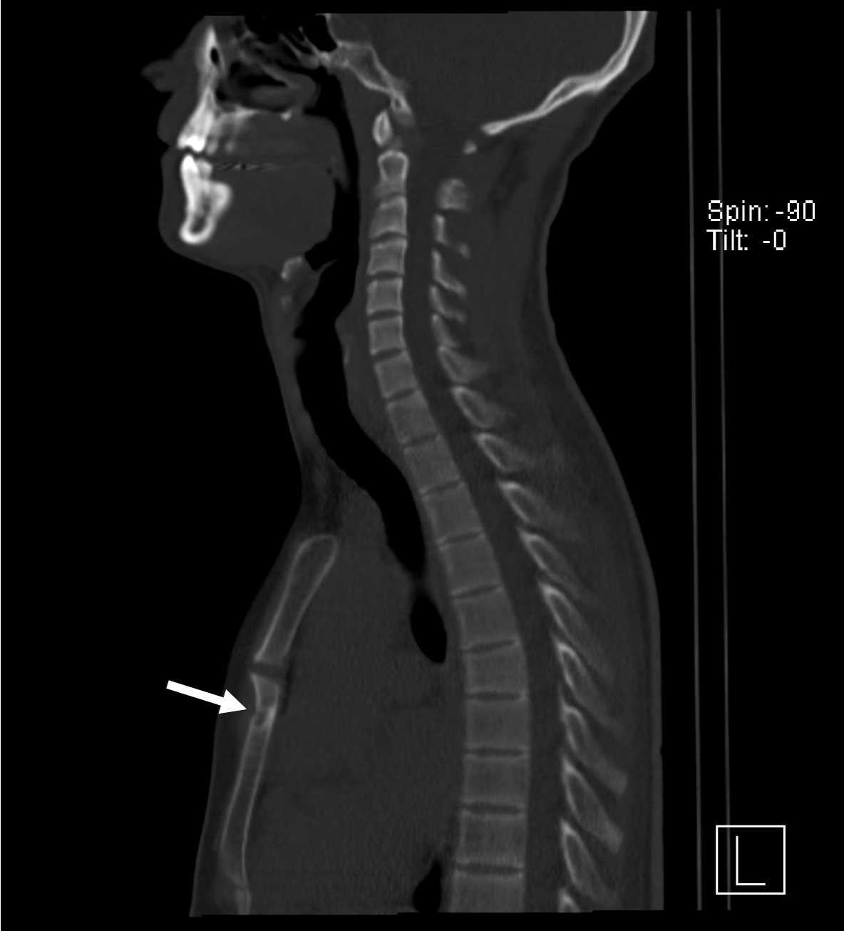 One dip too far an unusual cause of exercise induced chest pain [Sep