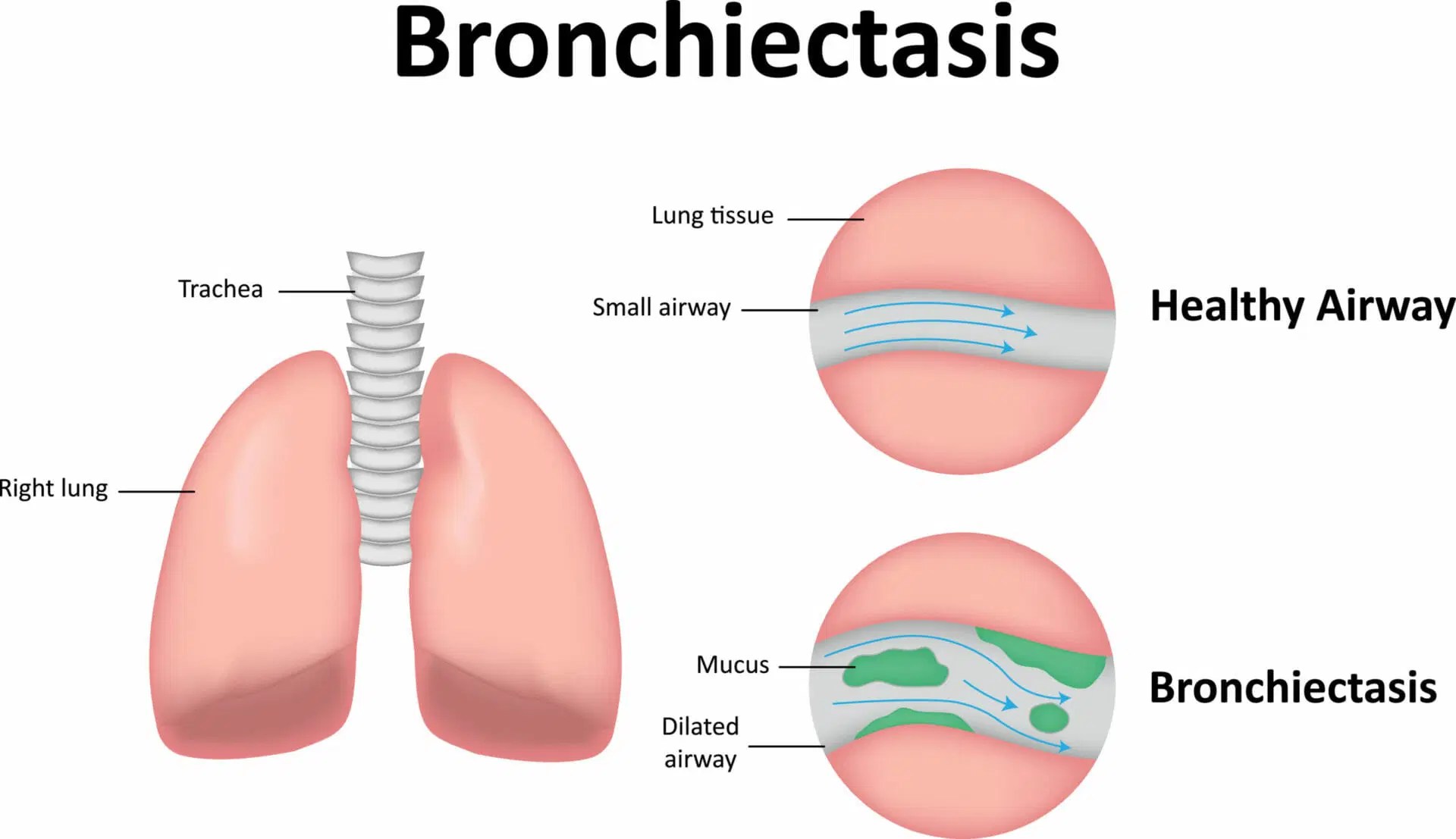 Bronchiectasis Bronchiectactis Treatment London Respiratory London