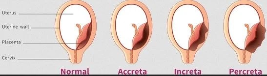 Placenta Percreta Definition. Symptoms. Signs. Treatment. Diagnosis