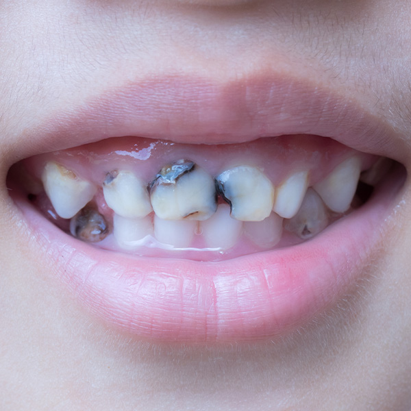 Dental Crowns Boston, MA Tooth Crown Dental Associates of New England