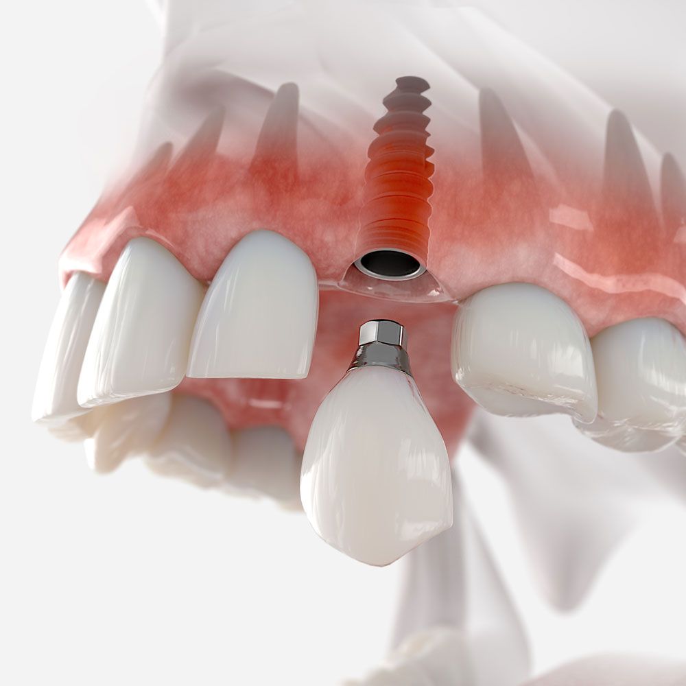 Dental Implants San Antonio, TX Implant Dentistry River City Dental
