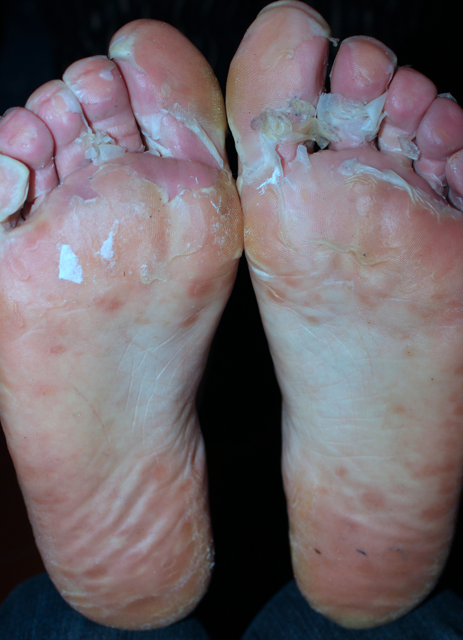 Onychomadesis Secondary To Hand Foot And Mouth Disease